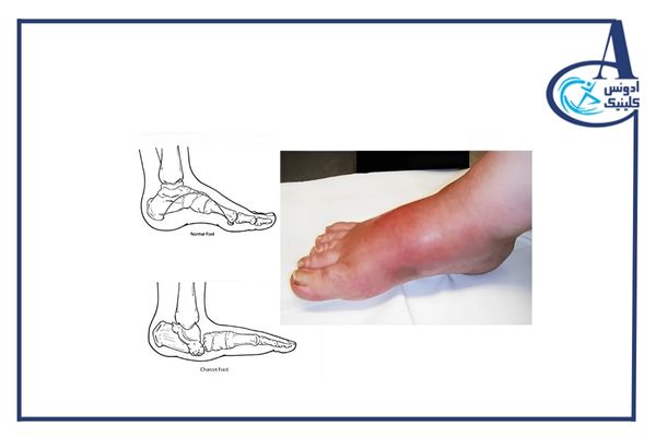 هر آنچه که باید درباره پای شارکو بدانید2